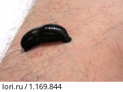 Гирудотерапия. Медицинская пиявка (Hirudo medicinalis) на ноге пациента. Стоковое фото, фотограф Татьяна Белова / Фотобанк Лори