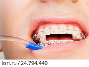 Man cleaning his teeth brace by brush. Стоковое фото, фотограф Сергей Новиков / Фотобанк Лори