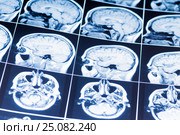 MRI of the brain. snapshot. Стоковое фото, фотограф Сергей Лабутин / Фотобанк Лори