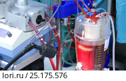 Device for cardiopulmonary bypass pumping blood. Стоковое видео, видеограф Швец Анастасия / Фотобанк Лори