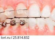 Split view of braces and tooth before them. Стоковое фото, фотограф Сергей Новиков / Фотобанк Лори