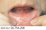 Close-up of stomatitis into mouth. Стоковое видео, видеограф worker / Фотобанк Лори