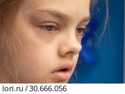 Заболевший ребенок, конъюнктивит на глазах. Стоковое фото, фотограф Иванов Алексей / Фотобанк Лори