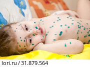 Portrait of cute little girl with sad eyes, kid lying on bed with chickenpox. Spots with green medicinal preparations on body. Varicella virus or Chickenpox. Стоковое фото, фотограф Кекяляйнен Андрей / Фотобанк Лори