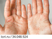 Enterovirus Leg arm mouth Rash on the body of a child Cocksackie virus. Стоковое фото, фотограф Irina Kuchugurina/Gaudy / Фотобанк Лори