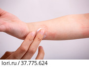 Мама мажет кремом руку ребенка с атопическим дерматитом. Руки крупным планом. Стоковое фото, фотограф Владимир Ходатаев / Фотобанк Лори