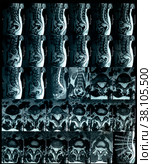 Magnetic resonance imaging film spine discs protrusion. Стоковое фото, фотограф Camptoloma / Фотобанк Лори