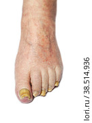 Fungal Nail Infection. Стоковое фото, фотограф Lekcej / Фотобанк Лори