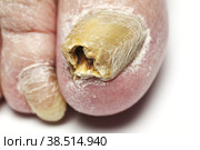 Fungal Nail Infection. Стоковое фото, фотограф Lekcej / Фотобанк Лори