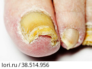 Fungal Nail Infection. Стоковое фото, фотограф Lekcej / Фотобанк Лори
