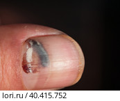 Close-up of a finger with a hematoma under the nail as a result of a bruise. A bruise under the nail plate. A bruised finger with a red-black hematoma. Wounded human hand finger nail. Стоковое фото, фотограф Александр Кротков / Фотобанк Лори