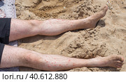 A sunbathing adult man lies on the sand with pale legs with red patches of psoriasis. Skin disease with psoriatic ulcers. Стоковое фото, фотограф Коханова Наталья / Фотобанк Лори