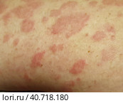 Urticaria blisters on the skin. Severe allergic skin reaction. Стоковое фото, фотограф Оксана Медведева / Фотобанк Лори