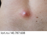Abscess furuncle carbuncle on male hairy back. Clogged pore leading to skin inflammation. Surgical solution of cosmetic problems. Redness, swelling and pimple formation. Dermatology and surgery. Стоковое фото, фотограф Юлия Петровская / Фотобанк Лори