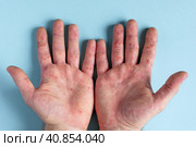 Painful rash, red spots blisters on the hand. Close up Allergy rash, human hands with dermatitis and Health problem. Ill eczema skin of patient. Viral Diseases. Red rashes on the palm. Enterovirus. Стоковое фото, фотограф Марина Демидюк / Фотобанк Лори