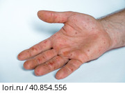 Male hands with Monkeypox rash. Patient with MonkeyPox viral disease. Close Up of Painful rash, red spots blisters on the skin. Human palm with Health problem. Banner, copy space. Allergy, dermatitis. Стоковое фото, фотограф Марина Демидюк / Фотобанк Лори