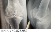 Plain X ray of the knee shows apparent joint osteoarthritis according to Kellgren and Lawrence system, subchondral sclerosis, knee joint inflammation. Стоковое видео, видеограф Ирина Старикова / Фотобанк Лори