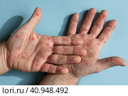 Male hands with Monkeypox rash. Patient with MonkeyPox viral disease. Close Up of Painful rash, red spots blisters on the skin. Human palm with Health problem. Banner, copy space. Allergy, dermatitis. Стоковое фото, фотограф Марина Демидюк / Фотобанк Лори