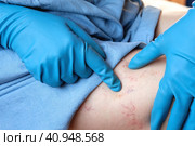 Phlebologist examines a patient with varicose veins on his leg. Leg pain. Phlebology. Venous pathologies of the lower extremities. Human vessel, arteries. Capillaries. Blood system. Health legs. Стоковое фото, фотограф Марина Демидюк / Фотобанк Лори