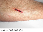 The Wound on a Leg of Young Man. Close Up. Open Red Wound, flows blood, Deep Cut, Dehiscence on Skin. Medical Concept. Laceration Closeup of a large erosion, freshly made, exposed capillaries. Стоковое фото, фотограф Марина Демидюк / Фотобанк Лори