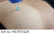 Needle injecting into the muscle. Nurse doing a trigger point injection in patient back. Close up doctor makes an shot therapy. Alternative pain treatment. Covid-19, pox, MPOX, flu virus vaccine. Стоковое видео, видеограф Марина Демидюк / Фотобанк Лори