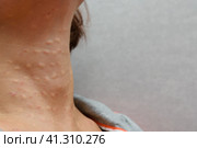 Close up photo of caucasian woman neck after biorevitalization procedure. Multiple injection marks are visible on the skin. Grey background. Фотография шеи белой женщины крупным планом после процедуры биоревитализации. На коже видны множественные следы от инъекций. Серый фон. Стоковое фото, фотограф Дмитрий Березнев / Фотобанк Лори