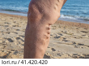 Woman's leg with varicose veins against the background of the sea. Spa treatment for sore legs. Стоковое фото, фотограф Коханова Наталья / Фотобанк Лори