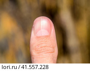 Forked nail on the thumb. Dilation of the nail, traumatic pathology. The nail is divided in half. Стоковое фото, фотограф Леонид Еремейчук / Фотобанк Лори