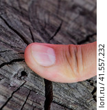 Forked nail on the thumb. Dilation of the nail, traumatic pathology. The nail is divided in half. Стоковое фото, фотограф Леонид Еремейчук / Фотобанк Лори