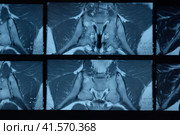 MRI sacroiliac articulation. Study of ankylosing spondyloarthritis patient. Стоковое фото, фотограф Леонид Еремейчук / Фотобанк Лори