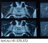MRI sacroiliac articulation. Study of ankylosing spondyloarthritis patient. Стоковое фото, фотограф Леонид Еремейчук / Фотобанк Лори