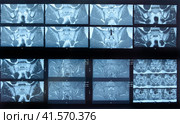 MRI sacroiliac articulation. Study of ankylosing spondyloarthritis patient. Стоковое фото, фотограф Леонид Еремейчук / Фотобанк Лори