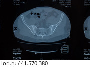 MRI sacroiliac articulation. Study of ankylosing spondyloarthritis patient. Стоковое фото, фотограф Леонид Еремейчук / Фотобанк Лори