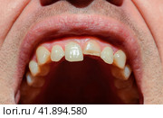Broken tooth. Broken upper incisor in a man mouth. Стоковое фото, фотограф Леонид Еремейчук / Фотобанк Лори
