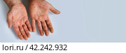 Human Hands with Painful Rash, Red Spots Blisters on the Skin. Health Problem. Monkeypox Disease Symptoms. Male Patient Arms with Monkey Pox. Close Up. Banner, Copy Space. Dengue Fever Infection, MPOX. Стоковое фото, фотограф Марина Демидюк / Фотобанк Лори