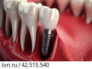 Dental implant. Generate Ai. Стоковое AI-изображение, AI-художник Иван Рябоконь / Фотобанк Лори