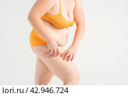 Overweight woman, fat legs with varicose veins and stretch marks, obesity female body with cellulite on gray background. Стоковое фото, фотограф Станислав Тарко / Фотобанк Лори