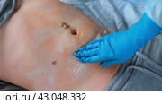 Hands of medic or nurse in blue gloves examining a fresh suture on a male stomach after laparoscopy surgical removal of appendicitis. Doctor examines of the patient. Man belly with medical stitches. Стоковое видео, видеограф Марина Демидюк / Фотобанк Лори
