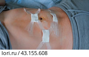 Hands of medic or nurse in blue gloves examining a fresh suture on a male stomach after laparoscopy surgical removal of appendicitis. Doctor examines of the patient. Man belly with medical stitches. Стоковое видео, видеограф Марина Демидюк / Фотобанк Лори
