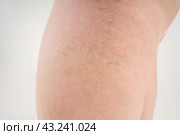 Human spider varicose veins closeup, fat female legs on white background. Стоковое фото, фотограф Станислав Тарко / Фотобанк Лори