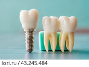 Dental implant model. Zirconium teeth crowns with a metal screw implant on blurry turquoise background. Стоковое AI-изображение, AI-художник Алеся Цапенко / Фотобанк Лори