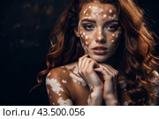 Leukoderma. Vitiligo. Violation of skin pigmentation. Large white spots all over the body and face. Portrait of a beautiful girl with a skin disease. Стоковое AI-изображение, AI-художник Photojuli / Фотобанк Лори