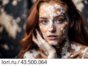 Leukoderma. Vitiligo. Violation of skin pigmentation. Large white spots all over the body and face. Portrait of a beautiful girl with a skin disease. Стоковое AI-изображение, AI-художник Photojuli / Фотобанк Лори