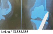 X-ray of the endoprosthesis knee joint after surgery. Стоковое видео, видеограф Ирина Старикова / Фотобанк Лори