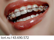 A woman with braces on her teeth is smiling. Стоковое AI-изображение, AI-художник Ярославский Максим / Фотобанк Лори
