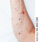 Heat burn of a person's hand from welding. Spot burns on the patient's forearm. Work injury concept. Стоковое фото, фотограф Дмитрий Кобзев / Фотобанк Лори