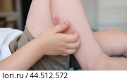 Child scratch body has sensitive itchy skin. Bodily rash. Kid allergy closeup. Little baby scratches eruption. Irritation, hive. Pruritus. Mosquito insect bite. Red from sunburn, Seborrheic Dermatitis. Стоковое видео, видеограф Марина Демидюк / Фотобанк Лори