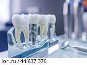Dental implant model display in clinic. Стоковое AI-изображение, AI-художник Иван Рябоконь / Фотобанк Лори