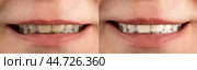 Smile before and after using bleaching agent, toothpaste, professional teeth cleaning. Partial view of smiling woman before and after teeth whitening. Стоковое фото, фотограф Павел Муравьев / Фотобанк Лори