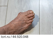 An old woman's leg. A foot with unkempt long nails and a sore big toe joint. Стоковое фото, фотограф Коханова Наталья / Фотобанк Лори